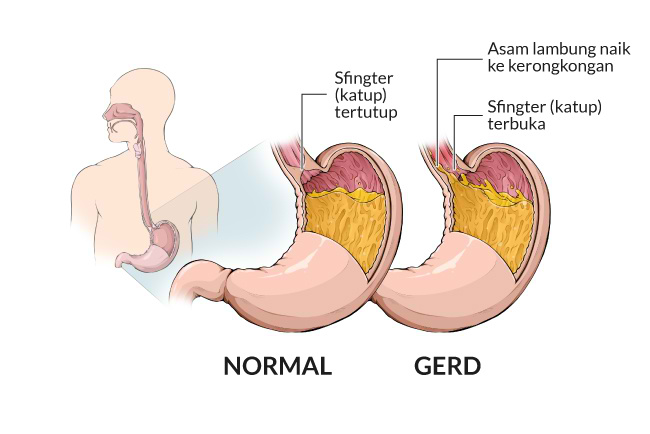 Penyebab GERD: Memahami Faktor yang Mempengaruhi